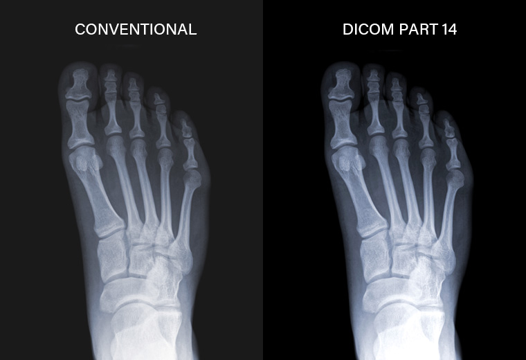 X-ray image of the soles of right foot presented under DICOM